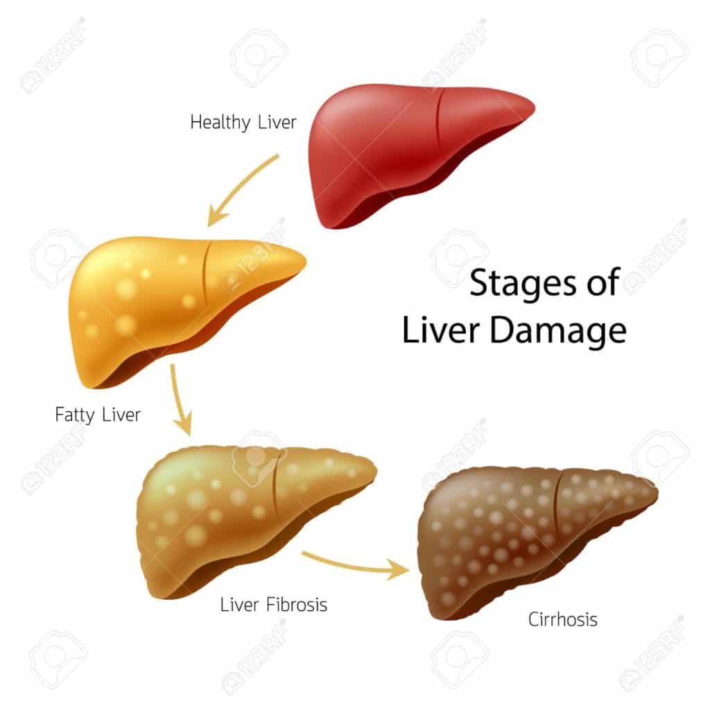 Beneficial Tips for Liver Detoxification