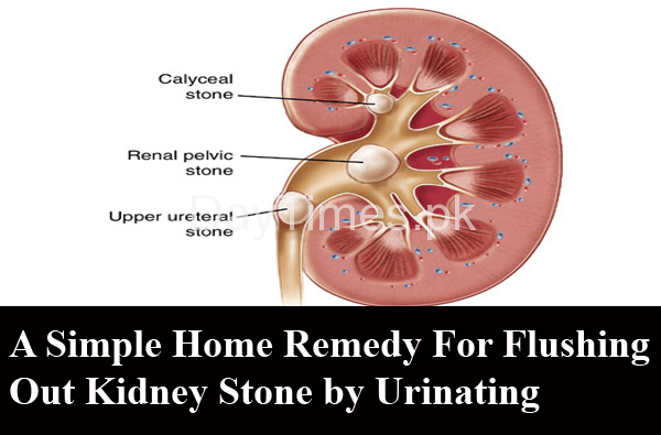 A Simple Home Remedy For Flushing Out Kidney Stone by Urinating