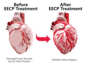 EECP Therapy in Pakistan