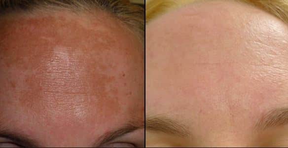 HydraFacial For hyperpigmentation