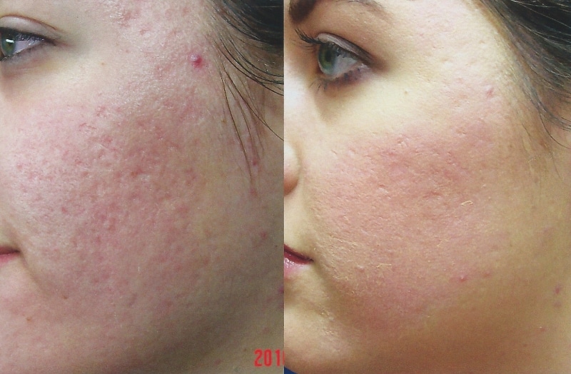 HydraFacial For Acne and Acne Scar