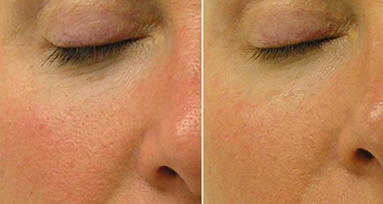 HydraFacial For Anti-aging