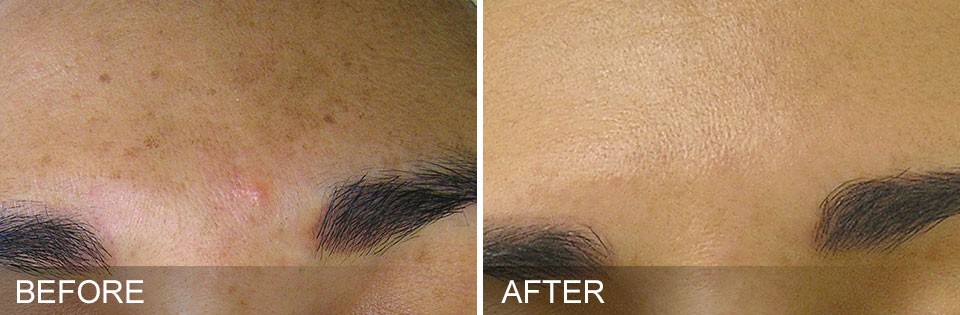 What are the HydraFacial treatment Results?