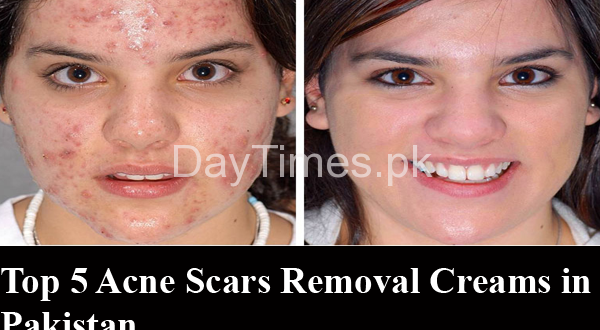 Top 5 Acne Scar Removal Creams in Pakistan