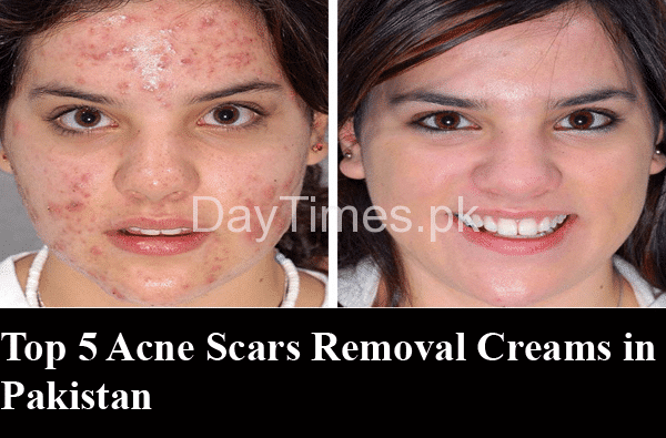 Top 5 Acne Scar Removal Creams in Pakistan