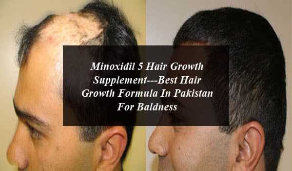 Minoxidil 5 Hair Growth Supplement---Best Hair Growth Formula In Pakistan For Baldness