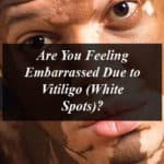 Are You Feeling Embarrassed Due to Vitiligo (White Spots)? Try Out Natural Ways To Treat It