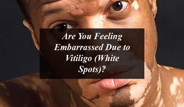 Are You Feeling Embarrassed Due to Vitiligo (White Spots)? Try Out Natural Ways To Treat It