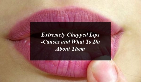 Extremely Chapped Lips -Causes and What To Do About Them
