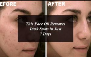 4 Best Dark Spots Removal Creams in Pakistan