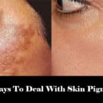 5 Best Ways To Deal With Skin Pigmentation