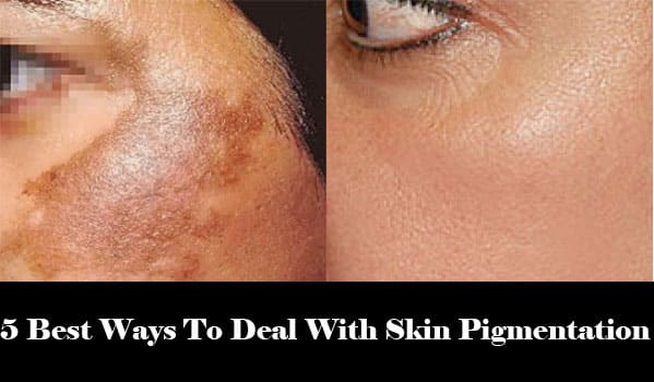 5 Best Ways To Deal With Skin Pigmentation