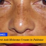 5 Best Anti-Melasma Creams in Pakistan