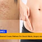 10 Best Scar Removal Creams in Pakistan For Stretch Marks, Surgery and Acne