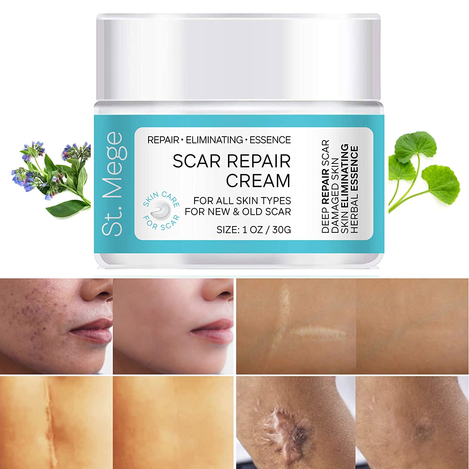 10 Best Scar Removal Creams in Pakistan For Stretch Marks, Surgery and Acne