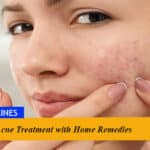Acne Treatment with Home Remedies