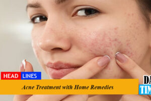 Acne Treatment with Home Remedies