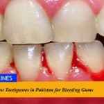 Best Toothpastes in Pakistan for Bleeding Gums