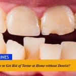 How to Get Rid of Tartar at Home without Dentist?