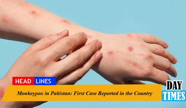 Monkeypox in Pakistan: First Case Reported in the Country