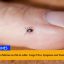 Congo Virus in Pakistan on Eid-ul-Adha: Congo Virus, Symptoms and Treatment