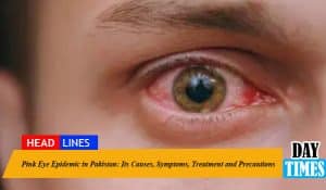 Pink Eye Epidemic in Pakistan: Its Causes, Symptoms, Treatment and Precautions 