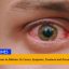 Pink Eye Epidemic in Pakistan: Its Causes, Symptoms, Treatment and Precautions 