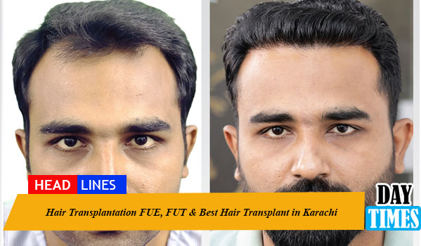 Experienced surgeon performing advanced hair transplant procedure at Hash Clinics in Karachi